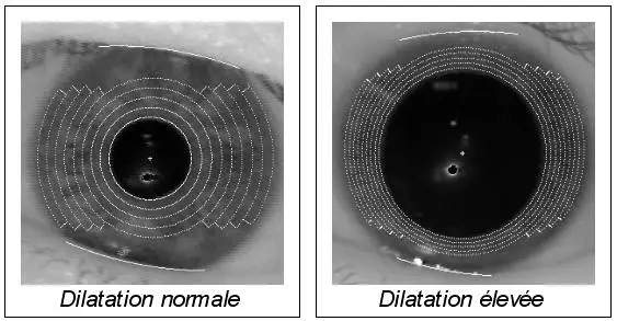 Dilatation de l'iris http://www.oki.com